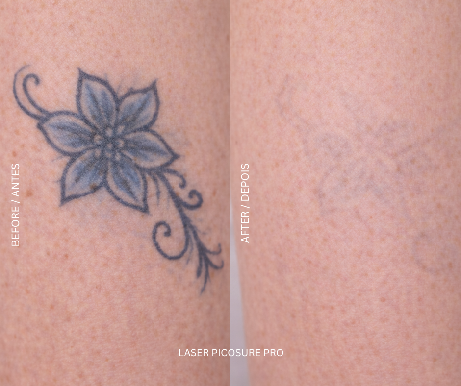 PicoSure Pro 2